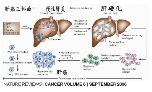 慢性肝炎,肝硬化,肝癌,为肝病三部曲,绝对不能轻忽.