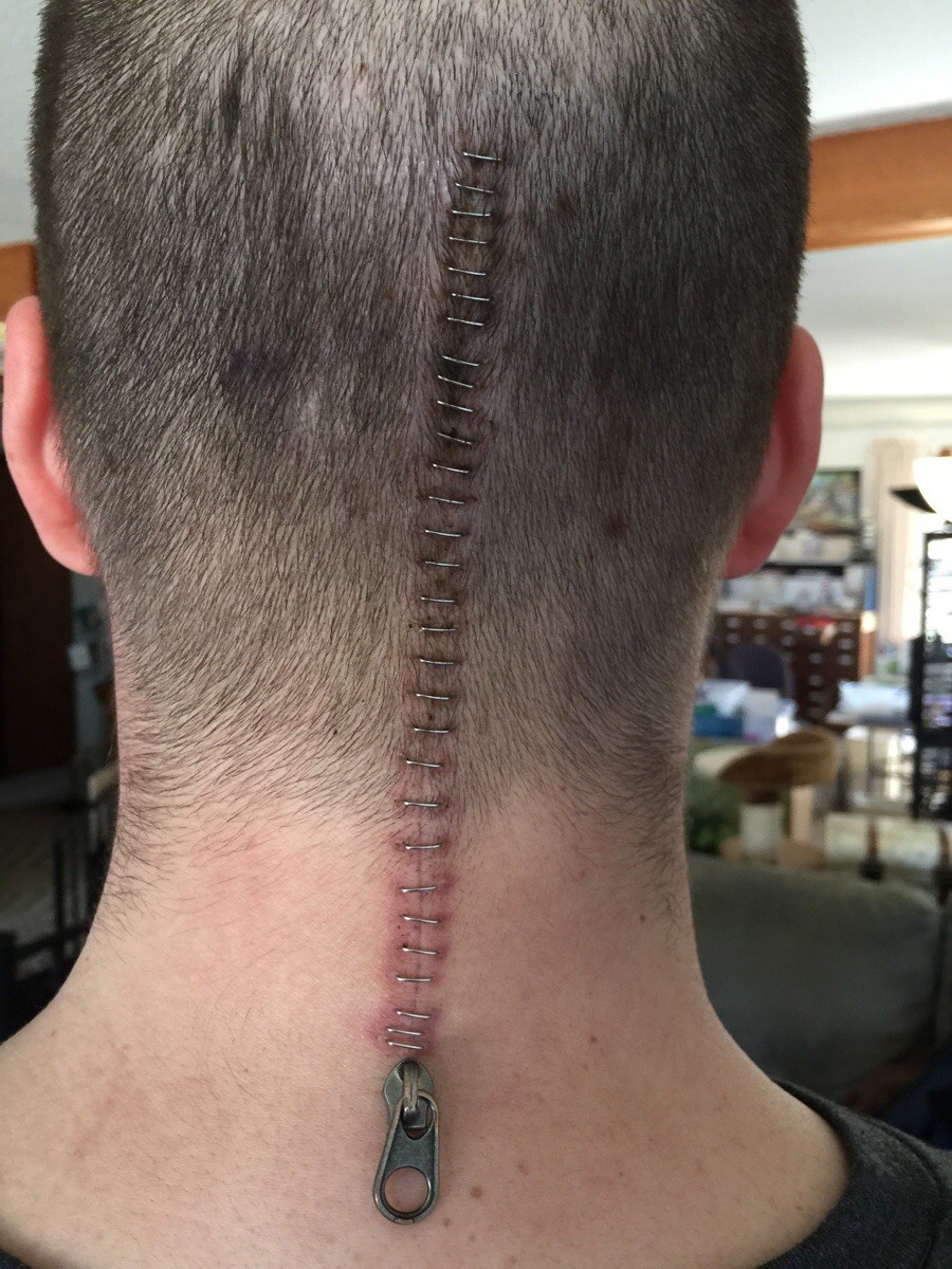 抗癌男子乐观po上手术后的疤痕拉鍊照.(图/翻摄自imgur)