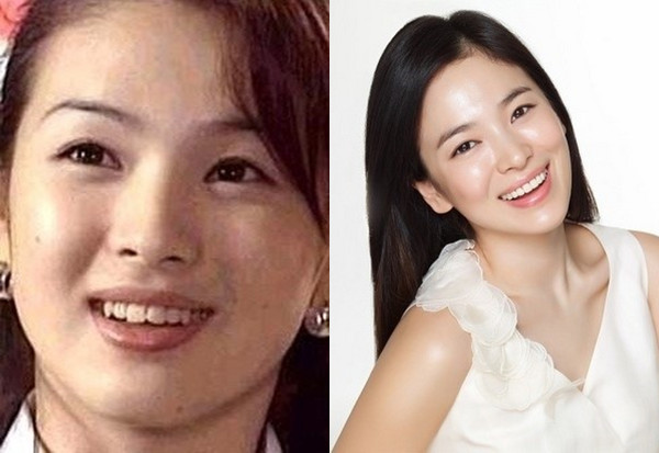整牙后的宋慧乔连婴儿肥也一起消失了呢(图/翻摄自naver coffee
