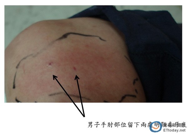 南投果农才拨开枝叶 「赤尾青竹丝」瞬间咬伤他手肘!