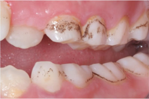 幼童牙齿冒黑点 饮食不当造成牙菌斑染色