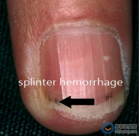 指甲纵裂症(longitudinal striations):在指甲表面呈线状隆起的纵痕