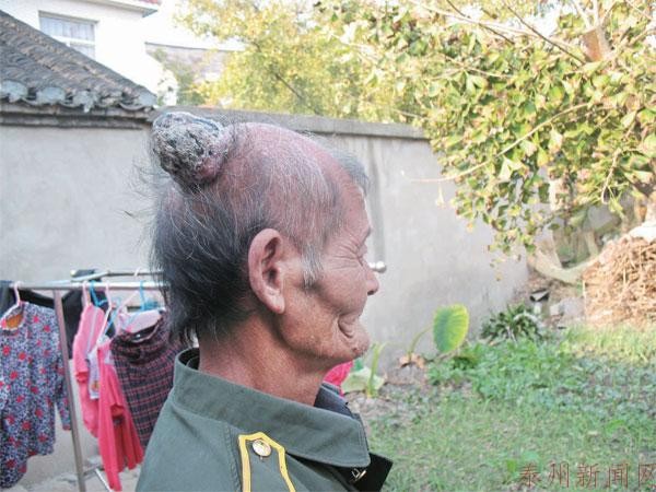 头上长6公分「犄角」 江苏男「肉瘤」越长越大