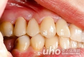 研究:孕妇罹患牙周病 生出低体重儿机率狂增7倍(图/优活健康网提供