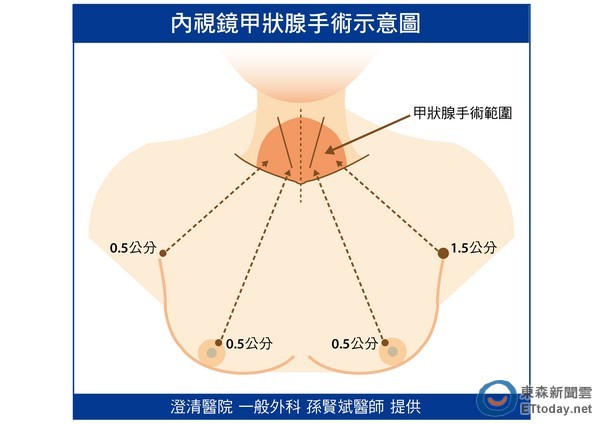 ▼内视镜甲状腺手术示意图.(图/澄清医院提供)