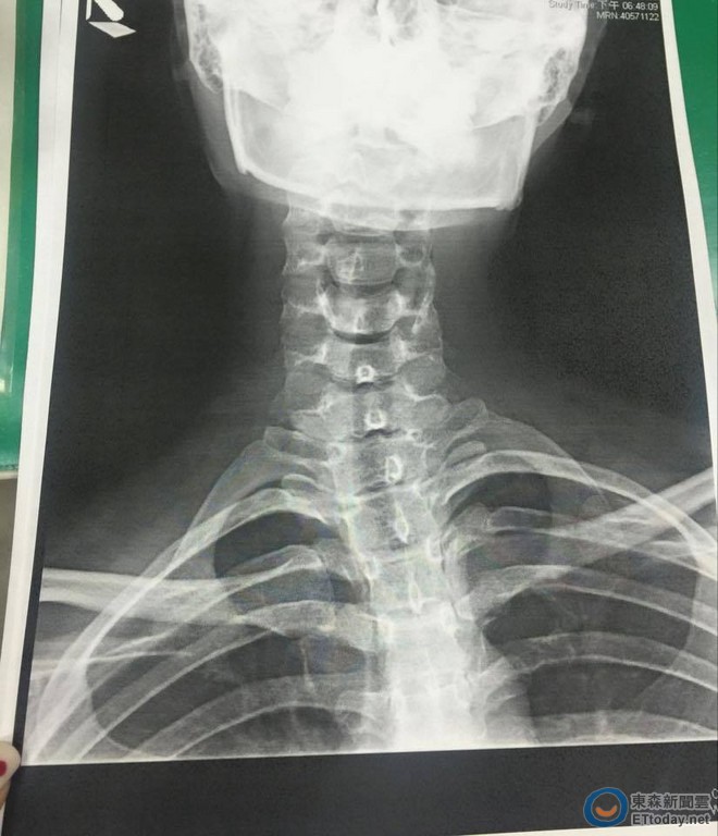 成语荞肩膀右倾45度工作喊停 就医针插肌肉爆