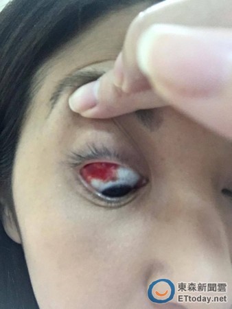 照镜子惊见「眼白染红」 本土剧女星操劳爆血