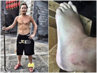 KID為贏隱瞞病情　腳踝外翻再內拐腫成「S型」