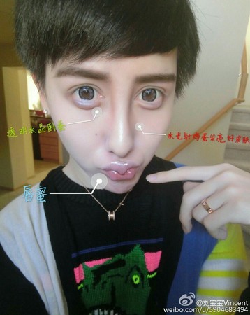 蛇精男 1天打14针玻尿酸  秀右脸炫耀:全都是针