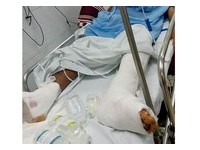 付8千治神經癱瘓　越南公立醫出包「手術左腳開右腳」