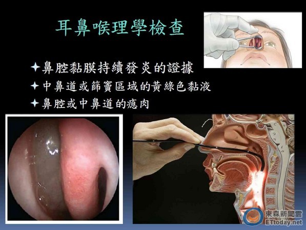 慢性鼻窦炎和一般感冒,过敏鼻炎 有何不同?