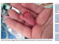 比拇指小的腳丫..世界最小的早產娃　226公克奇蹟存活