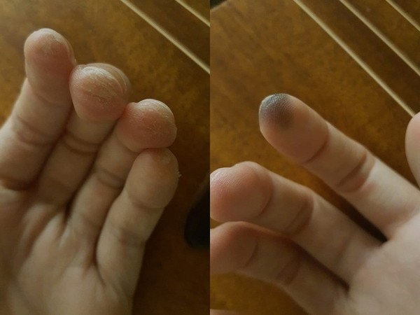 夏语心苦练吉他惊见黑手指 双手指尖狂脱皮像破洞