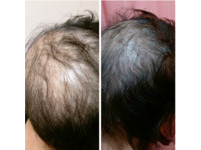 乳癌做化療頭頂毛掉光　針灸4穴位頭髮長回來了