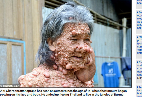 男子罹患「神经纤维瘤」,因怪异容貌隐居45年,为了悼念泰王终於鼓