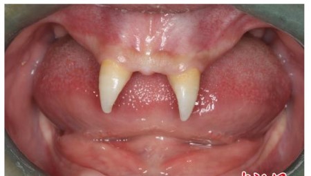 贵州一名16岁少年罹患罕见基因病,上颚部分长出两颗「獠牙」.