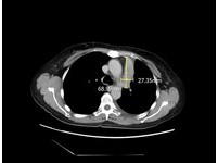 她肺癌骨轉移、胸腔積水仍存活7年 醫籲晚期癌勿放棄