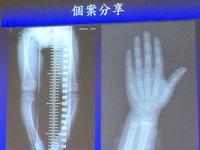 孩童持續性下肢變形及步態搖擺像鴨子步 可能是佝僂症!