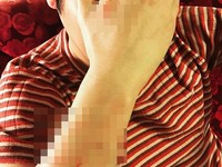 男星遮臉竟滿手紅色抓痕！　痛揭「家暴事件」驚呆網友