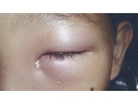 螞蟻鑽眼手揉碎…碎屍卡眼　2歲童「腫像核桃」差點失明