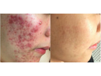 正妹滿臉痘痘膿胞不敢見人 口服「低劑量A酸」還她顏值