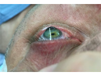 洋男隱眼戴不上「角膜凸成一顆球」　視力剩0.01險失明