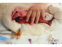 600克「巴掌女嬰」皮膚透明沒呼吸　9月後頑強不輸同齡