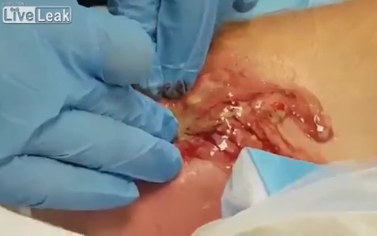 一位医生正在治疗被蜘蛛咬到的病患,血水与浓液不断从伤口被