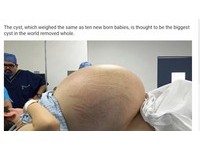 墨西哥女長31公斤卵巢囊腫　肚子腫得像塞了10個嬰兒