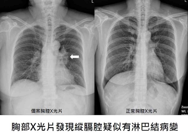 邱女士因长期咳嗽就诊,x光检查胸腔纵膈腔有病变.