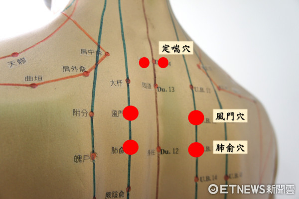 「三伏贴」进行特定穴位的中药敷贴(图/奇美医院提供)