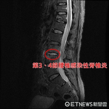 「感染性脊椎炎」上身 她下背痛卧床月余险瘫