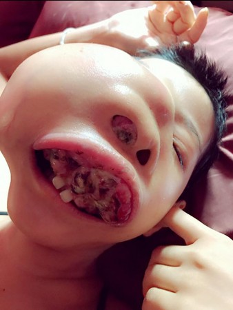近期病情加剧,鼻子大量出血,牙齿也开始脱落.