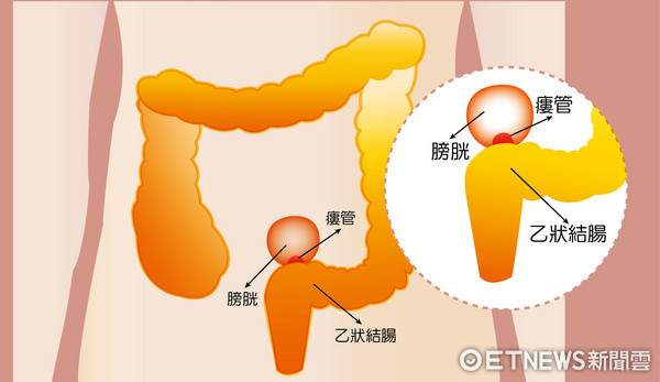 排出奇臭「粪尿 乙状结肠憩室惹祸