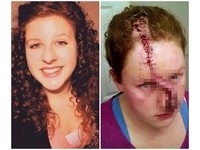 金髮正妹對抗皮膚癌3年　疤痕「從鼻頭延伸到額頭」