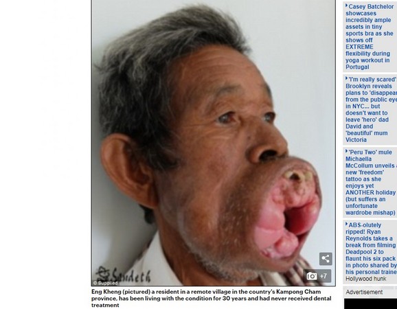 ▲柬埔寨男得怪病，長了巨大腫瘤。（圖／翻攝自每日郵報）