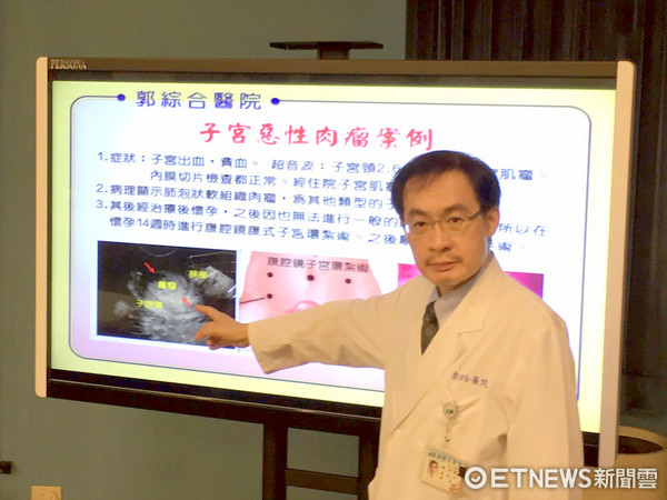 子宫肌瘤不一定是良性 小心潜藏的可怕恶性肉瘤