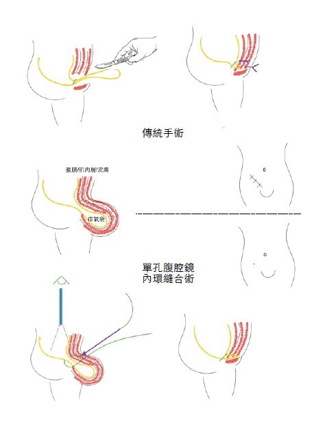 單孔腹腔鏡內環關閉手術疝氣。(圖/長庚醫院提供)