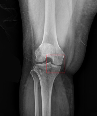 膝盖疼痛跛行竟是「半月板破裂」 手术助矫正