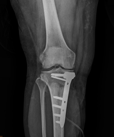 膝盖疼痛跛行竟是「半月板破裂」 手术助矫正