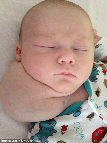 英国「双头」宝宝 割掉颈部巨大囊肿痊愈 | ET
