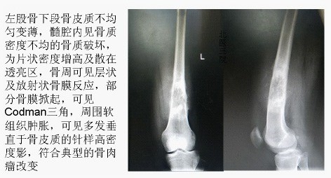 生活中心/综合报导 原本比较容易长在腿部的肿瘤,竟然跑到头颅里面!