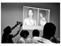 《變臉》真人版！福建燒傷少女肩胸部「養活」新臉