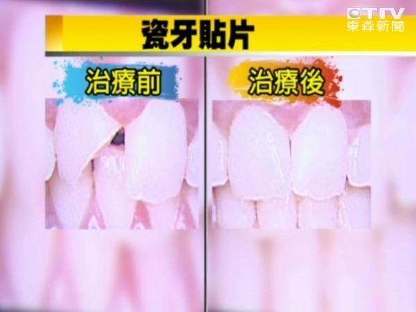 瓷牙贴片美白兼补缝 自费每颗一万五千元 | ET