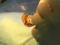 近視雷射手術後遺症疑慮　美眼科專家駁斥《ETtoday 新聞雲》