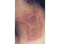 雨後「隱翅蟲」紛飛　蟲液害毀容《ETtoday 新聞雲》