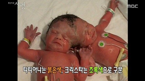 共用一颗头!加拿大9岁「<em>连体姊妹</em>」乐跳骑马舞