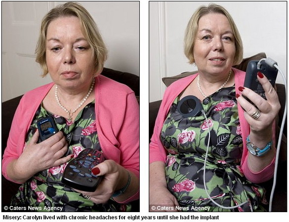d64661 是真的！英國婦人用「遙控器」止頭痛《ETtoday 新聞雲》