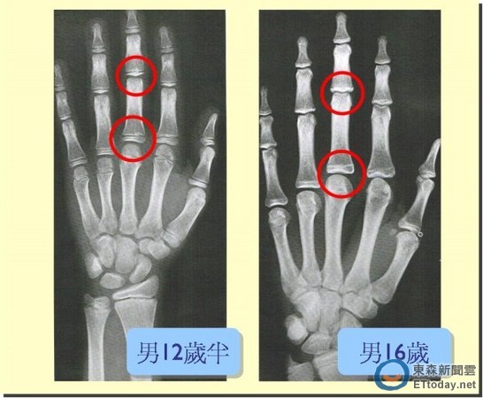 医师会透过x光片评估生长空间与潜能,查看骨龄及生长板是否关闭.