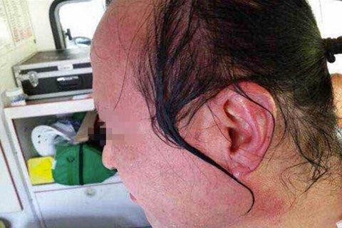 蒋姓教授脸部烫伤红肿,眼睛也难以睁开.(图/翻摄自《中新网》)